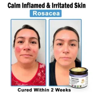 Coastglee® Bee Toxin Skin Treatment Cream