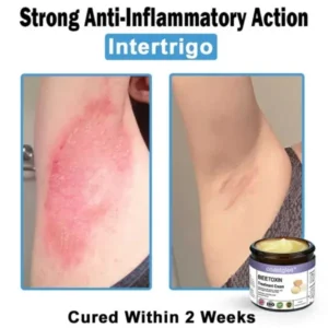 Coastglee® Bee Toxin Skin Treatment Cream