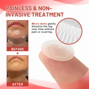 Coastglee® MicroDart Skin Tag Remover Patch