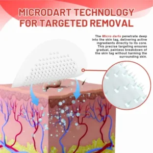 Coastglee® MicroDart Skin Tag Remover Patch